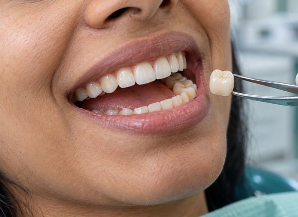 Zirconia Crowns Zirconia Crowns