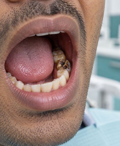 bad-tooth Bad Tooth