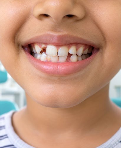 Crooked Teeth