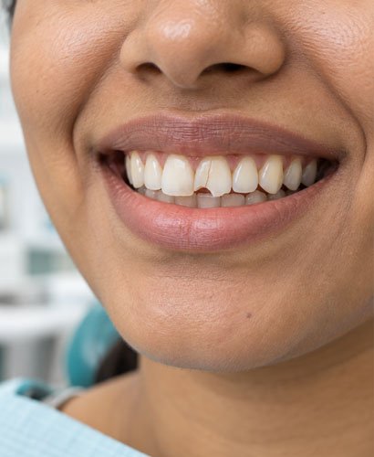 crack-tooth Crack Tooth