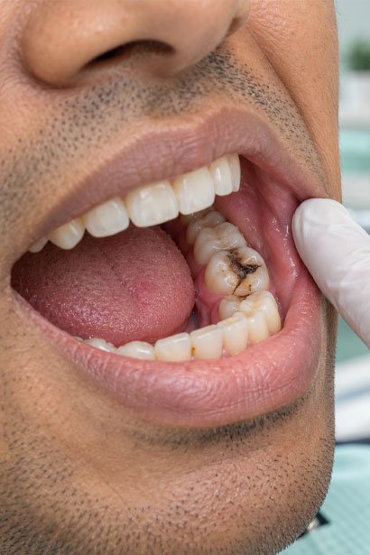 cracked-tooth Cracked Tooth
