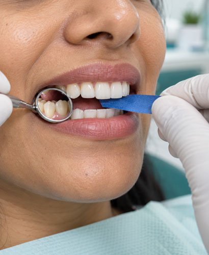 dental-crown-treatment Dental Crown Treatment