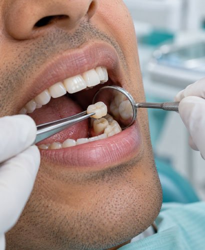 dental-crown Dental Crown Treatment