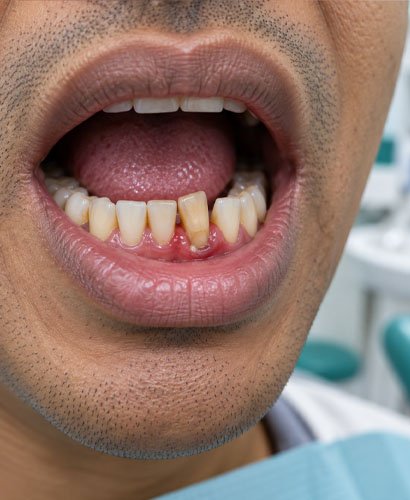 loose-tooth