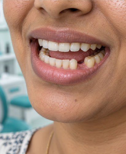 missing-tooth missing Tooth