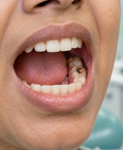 root-canal-teeth Root Canal