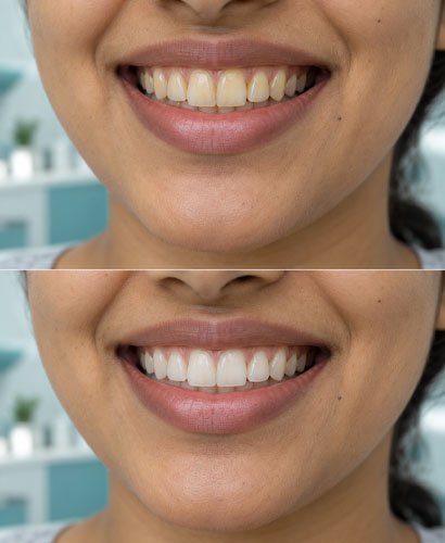 White Teeth