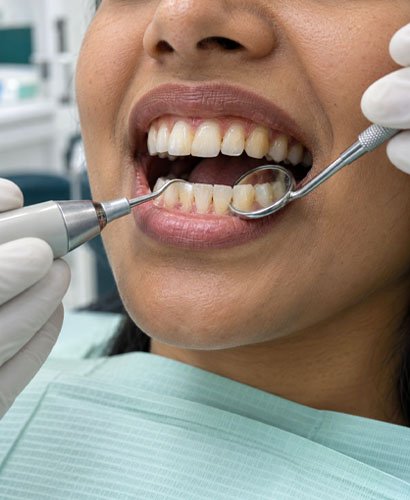 teeth-cleaning-treatment Teeth Cleaning