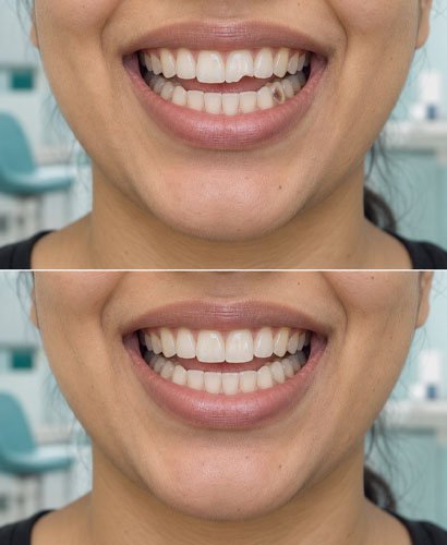 Tooth Color Filling