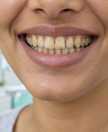 yellow-teeth Yellow Teeth
