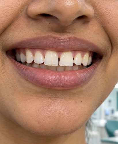Yellow Teeth